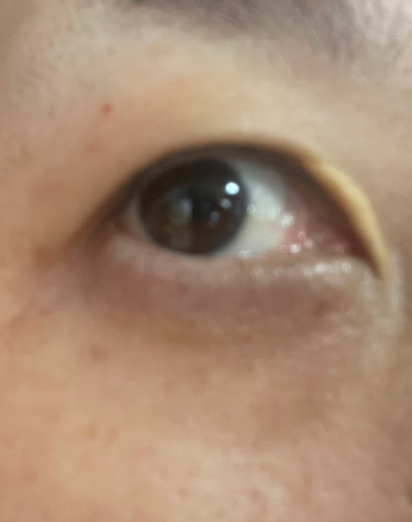 眼瞼黄色腫 術後2ヶ月右目