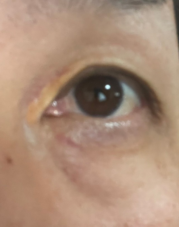 眼瞼黄色腫 術後2ヶ月左目